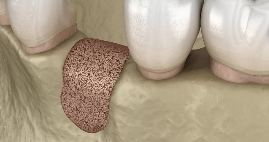 의정부 치과 뼈이식 임플란트