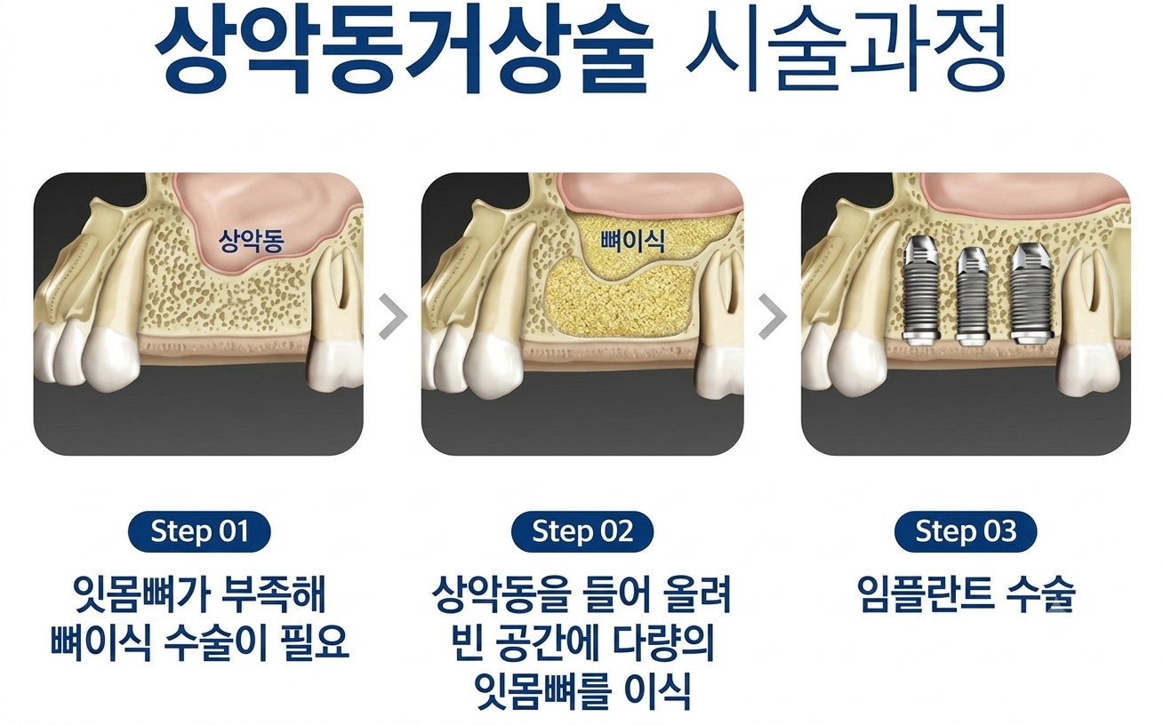 의정부 치과 든든치과 상악동거상술 설명