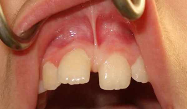 의정부 치과 Superior Labial Frenum Hypertrophy 설명하는 이미지
