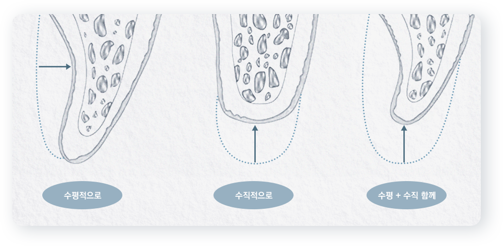 의정부 치과 수평성 골소실과 수직성 골결손의 차이와 잇몸재생치료를 설명하는 일러스트