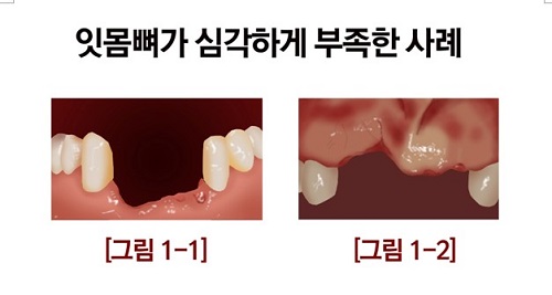 의정부 치과 든든치과 임플란트 전 잇몸 상태 확인