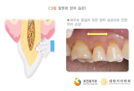 의정부 치과 치은퇴축의 원인을 설명하는 이미지