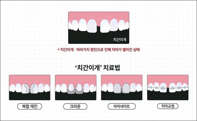 의정부 치과 치간이개 치료법을 설명하는 이미지