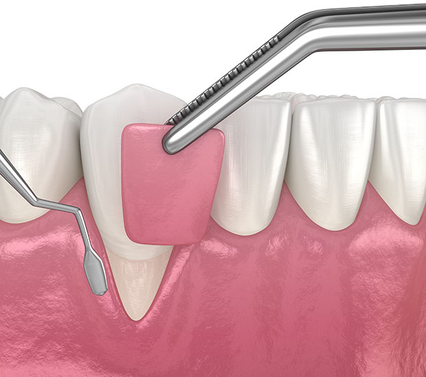 Gum Recession: Soft tissue graft surgery. 3D illustration of Dental  treatment